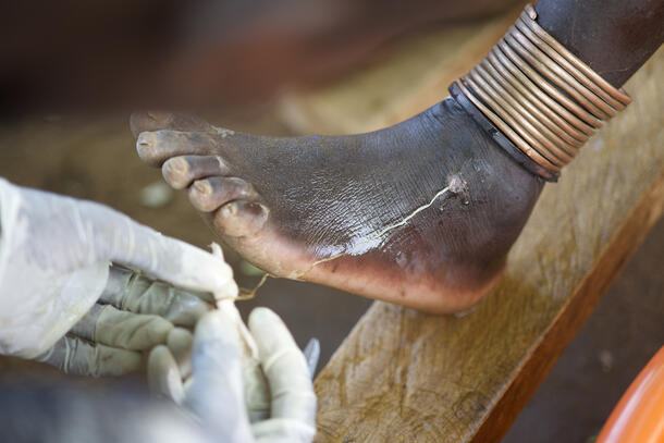 Hands wearing disposable gloves are removing a long thin Guinea worm protruding from a human foot by winding it around a gauze-covered stick.
