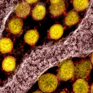 Color-enhanced image of SARS-CoV-2 virus particles.