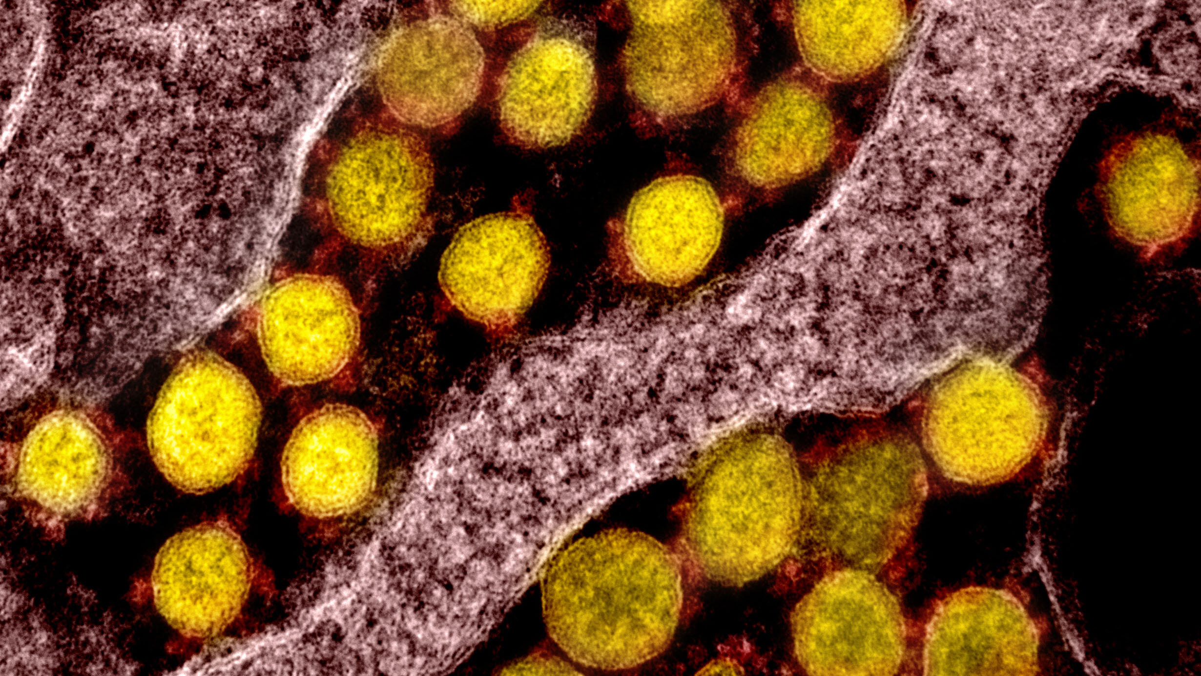 Color-enhanced image of SARS-CoV-2 virus particles.