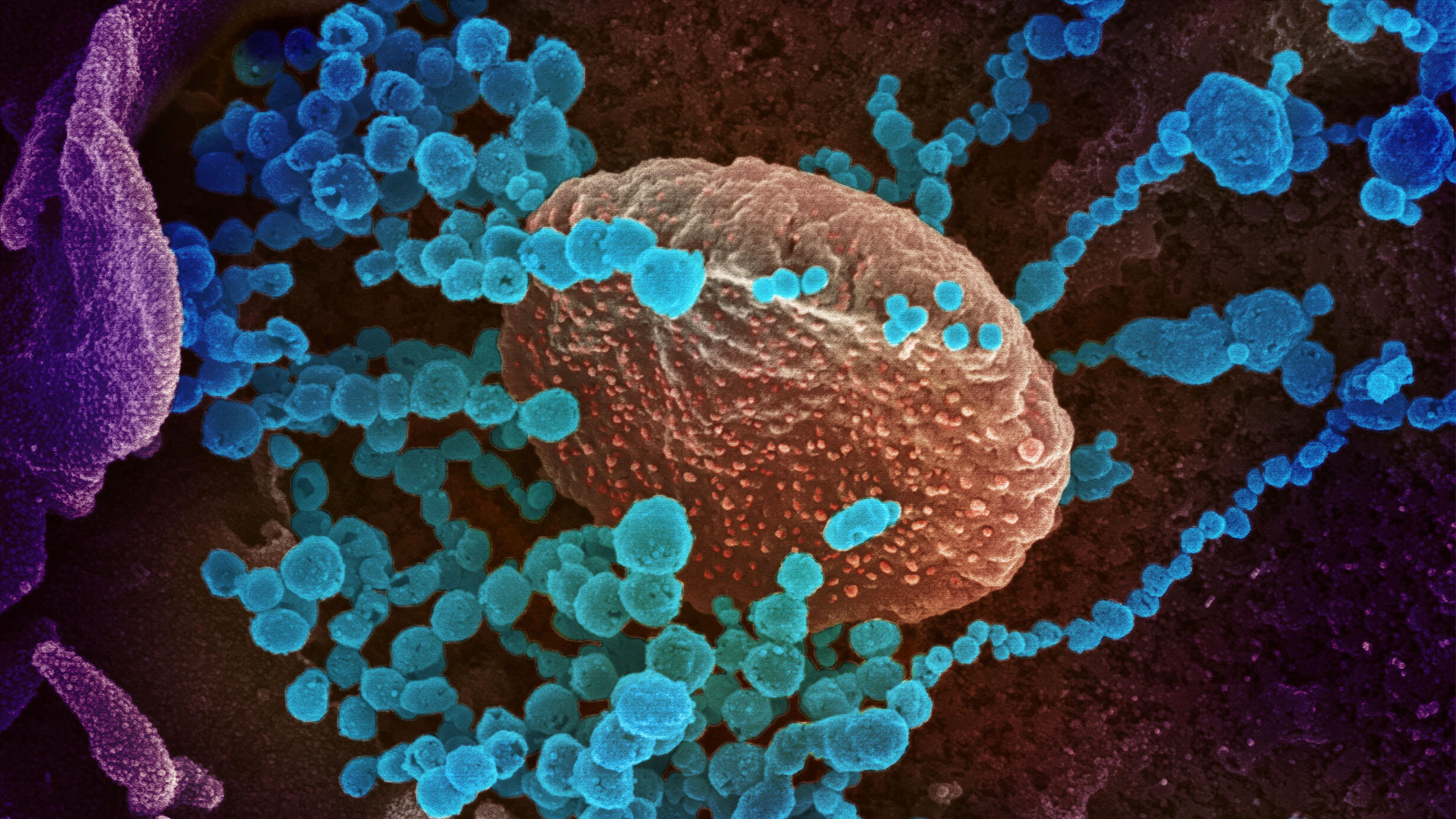 A scanning electron microscope image shows SARS-CoV-2 (small round objects) emerging from the surface of a cell.