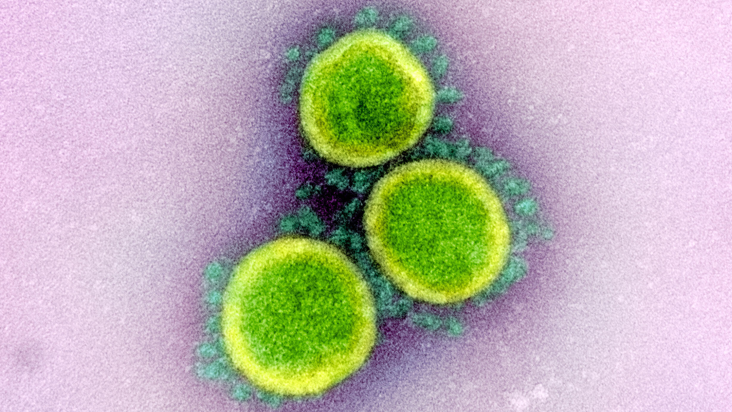 Color-enhanced image of SARS-CoV-2 virus particles.