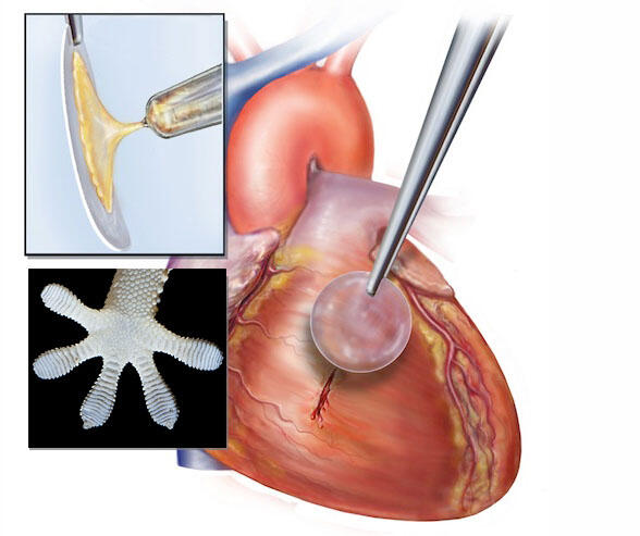 An illustration of a slim tool placing a patch on a tear on an anatomically accurate heart.