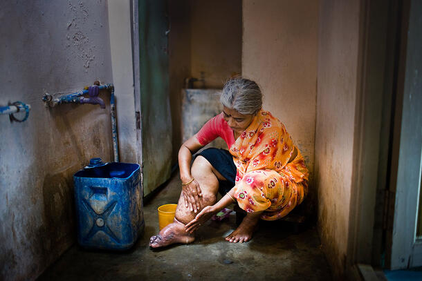 Usha sits on the floor of a small room and washes her swollen leg which has been affected by elephantiasis.