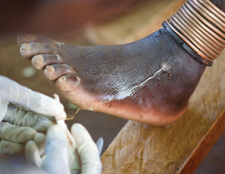 Close-up on a foot infected with guinea worm as a gloved hand extracts the guinea worm.
