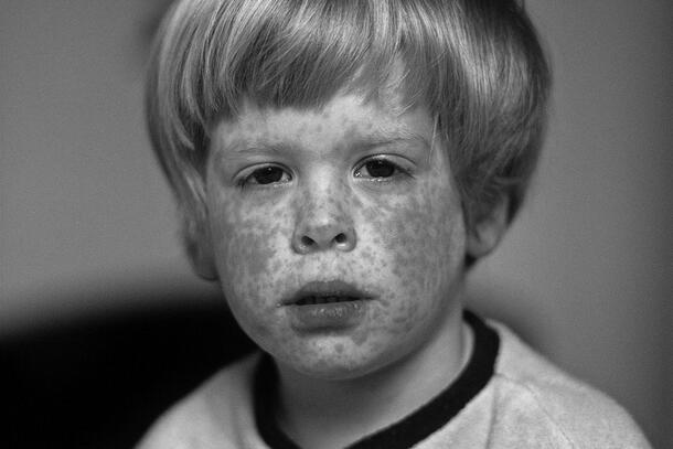 Close-up on the face of a child with measles.