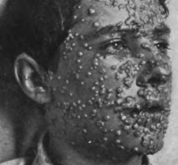 Close-up on the face of a smallpox patient covered in circular lesions.